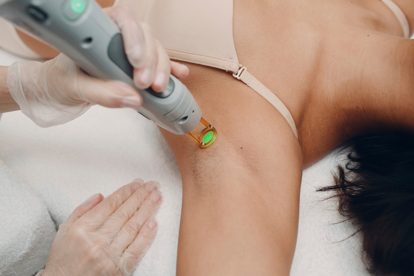 Laser hair removal